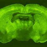 Testata nuova tecnica di terapia genica contro il Parkinson