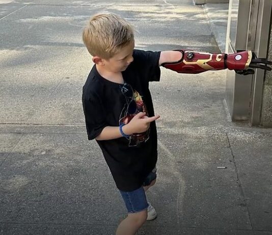 Bambino nato senza mano diventa un supereroe Bambino
