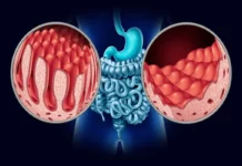 Celiachia, trovato innesco dell’intolleranza al glutine Celiachia