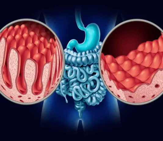 Celiachia, trovato innesco dell’intolleranza al glutine Celiachia
