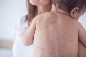 Morbillo in Italia