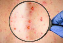 Morbillo in Italia: 432 casi nel 2025, sotto accusa i pochi vaccini Morbillo in Italia