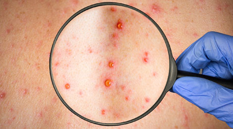 Piedmont Healthcare Morbillo in Italia
