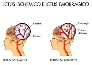 Ictus